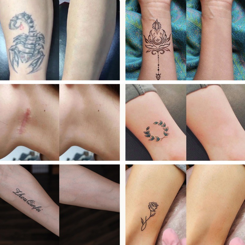 5 Miếng Dán Che Khuyết Điểm Hình Xăm - Birthmark Hide Tapes - Miếng Dán Che Sẹo - Kem Hỗ trợ giảm mụn - Hình Xăm Giả Cơ Thể - Trang Trí Nghệ Thuật DIY - Vô Hình, Chống Thấm Nước, Mô Phỏng