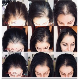 Kem mọc tóc dạng bọt Women's Rogaine Foam Treatmen Minoxidil 5% dành cho nữ [ TN 2025 ]