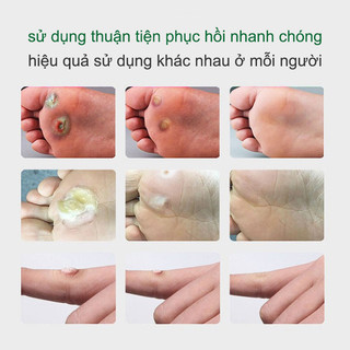 [ Tiến Sĩ Xanh] Kem Bôi Viêm Da Cơ Địa, Hắc Lào, Nấm Ngứa Đầu Chàm ,Tổ Đỉa Ghẻ Nước, Lang Ben, Á Sừng, Tuýp 15Gr