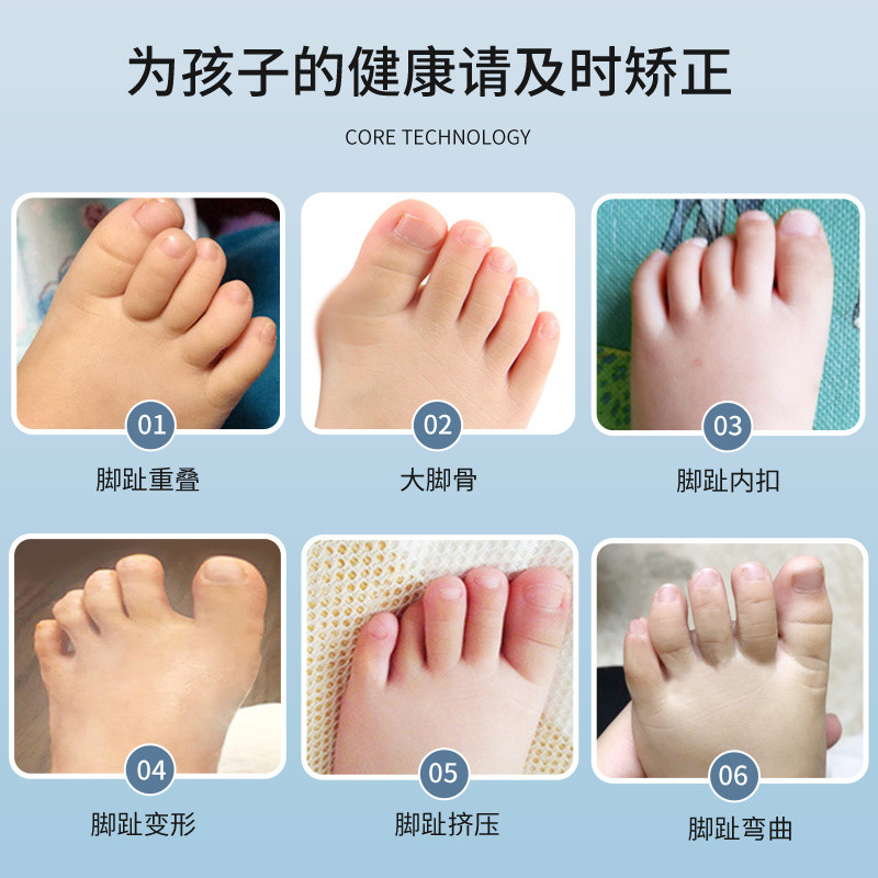 ✨✨Nền Tảng Bán Chạy Bé Ngón Chân Corrector Trẻ Em Chuyên Dụng Cho Bé Chồng Lên Ngón Chân Bộ Chia Chỉnh Dụng Cụ Tiện Dụng Ngón Tay Cái Valgus Trẻ Em Tập Đi 25.5.18