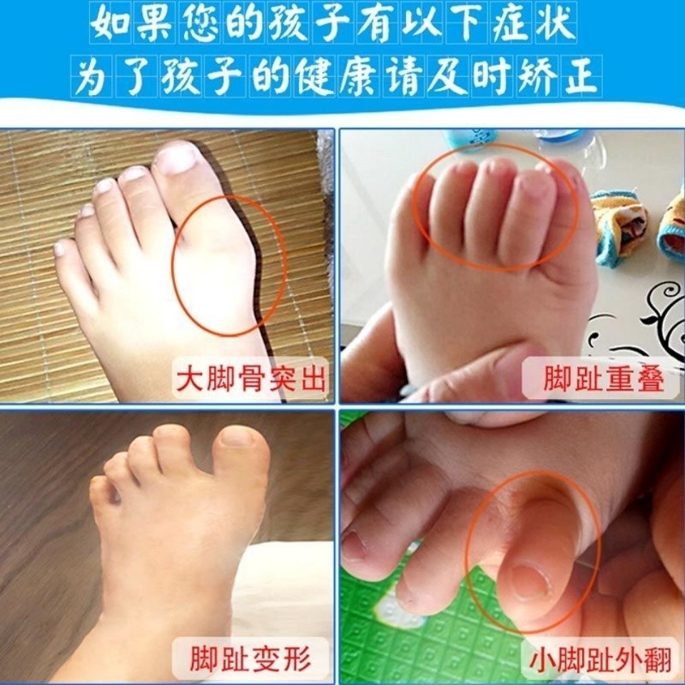 ✨✨Nền Tảng Bán Chạy Trẻ Em Mũi Corrector Bé Chồng Lên Ngón Chân Cái Valgus Chỉnh Sửa Ngón Chân Cho Bé Tách Ngón Chân 25.5.18