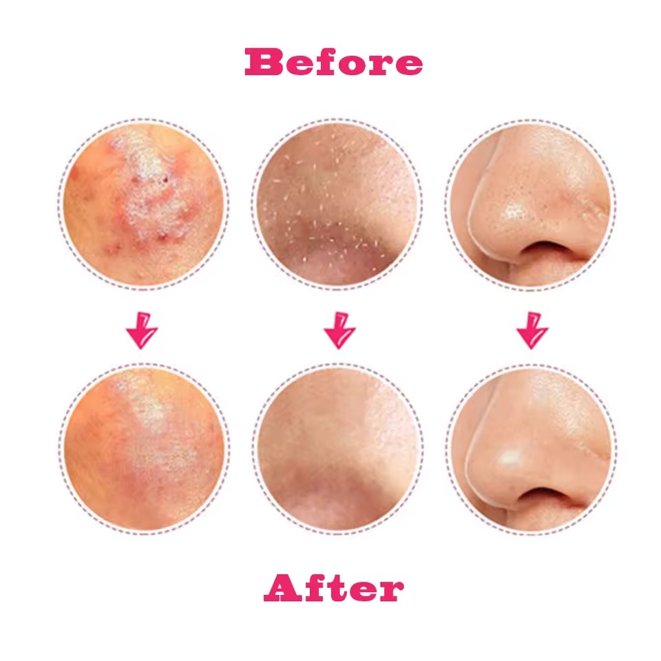 1 / 2 Salon Chăm Sóc Sắc Đẹp Đức Ultra - Fine No. Dụng cụ làm sạch nhíp mụn đầu đen 5 Cell