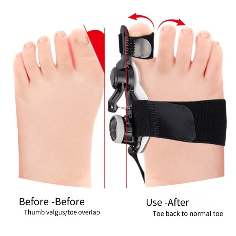 FL Bộ tách ngón chân lớn cho trẻ em Bộ chỉnh sửa Hallux Valgus có thể điều chỉnh Mũi to Nẹp Corrector cho trẻ em Ngày đêm Suppor