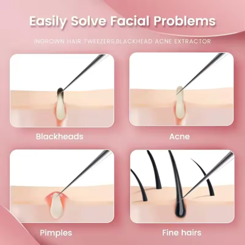 1 / 2 Salon Chăm Sóc Sắc Đẹp Đức Ultra - Fine No. Dụng cụ làm sạch nhíp mụn đầu đen 5 Cell