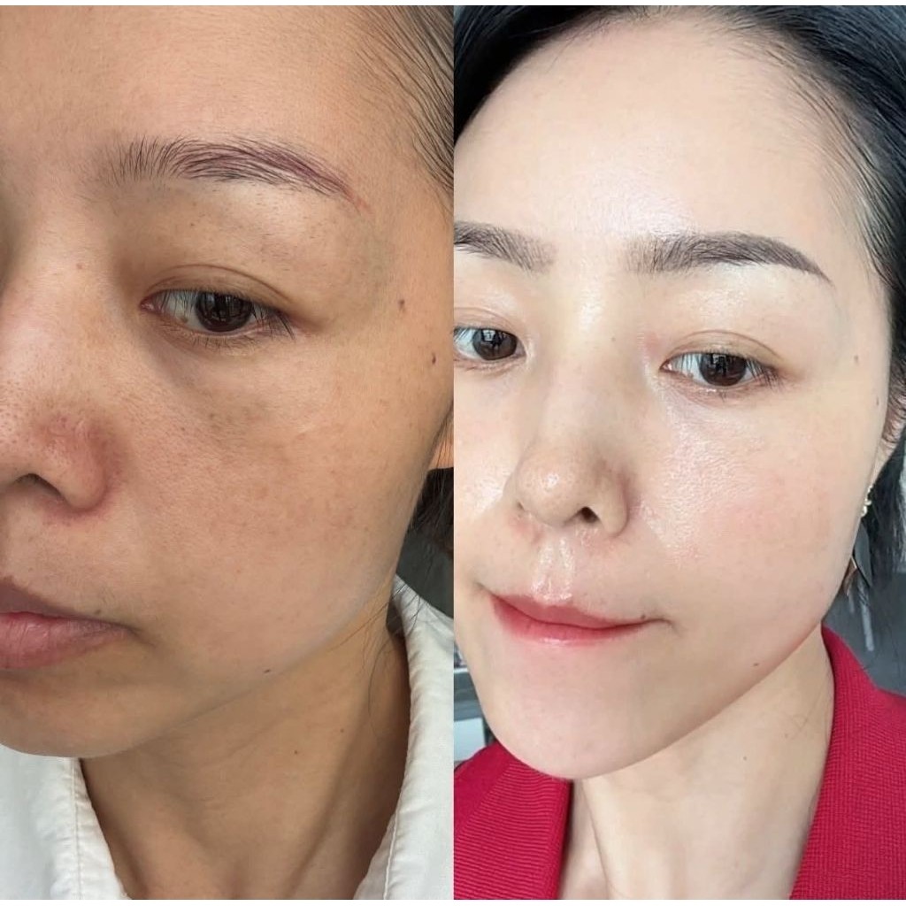 Kem Mờ Thâm Nám Trillumase Giảm Nám Tàn Nhang, Mờ Thâm, Làm Sáng & Đều Màu Da Tuýp 25g