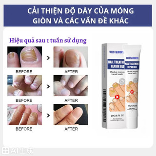 Kem phục hồi móng Móng kháng khuẩn chân loại nấm móng gãy móng chống Kem giúp hết nấm làm thối móng tay móng chân Tinh c