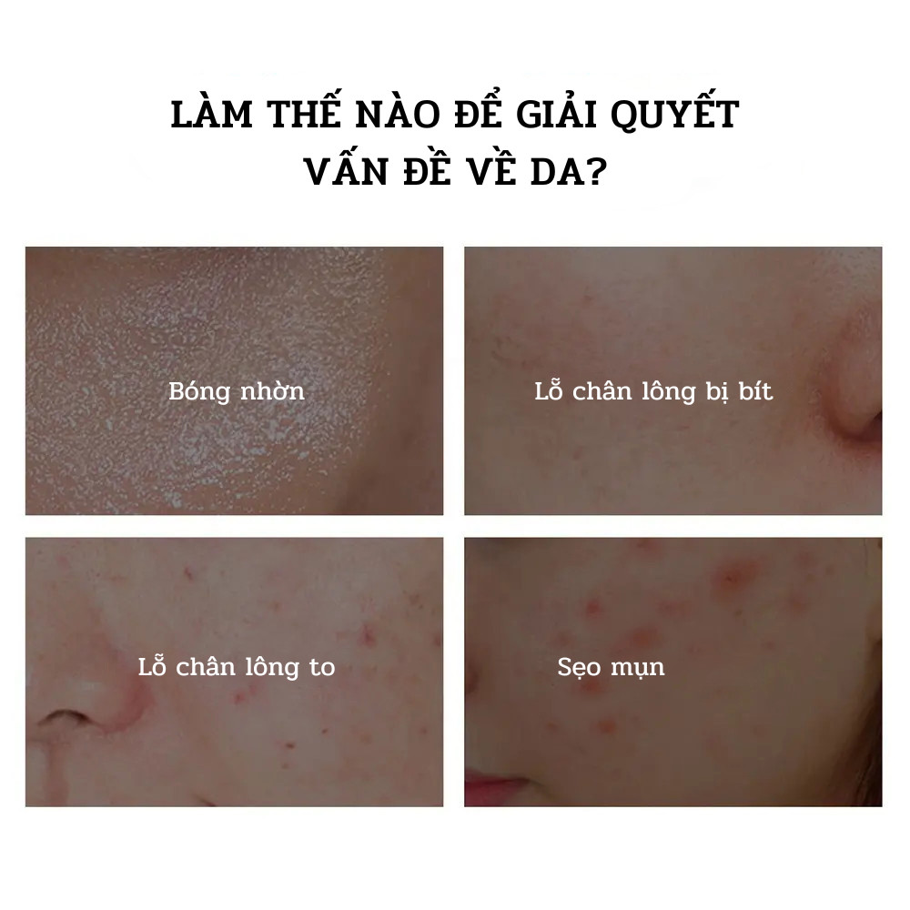 Kem Chuyên Biệt Giảm Thâm Mụn Chuyên Sâu Anti-Acne Sạch Mụn, Mờ Thâm 20gm