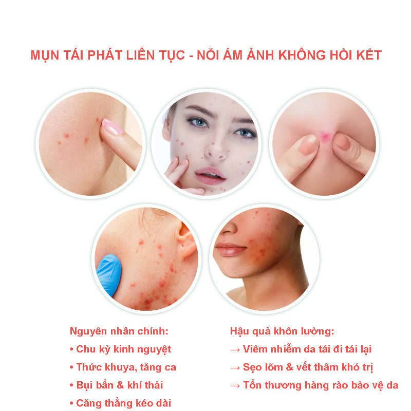Miếng Dán Mụn Hình Ngôi Sao 200 Miếng – Nhiều Màu Sắc, Vô Hình, Loại Bỏ Mụn Hiệu Quả, Chăm Sóc Da An Toàn