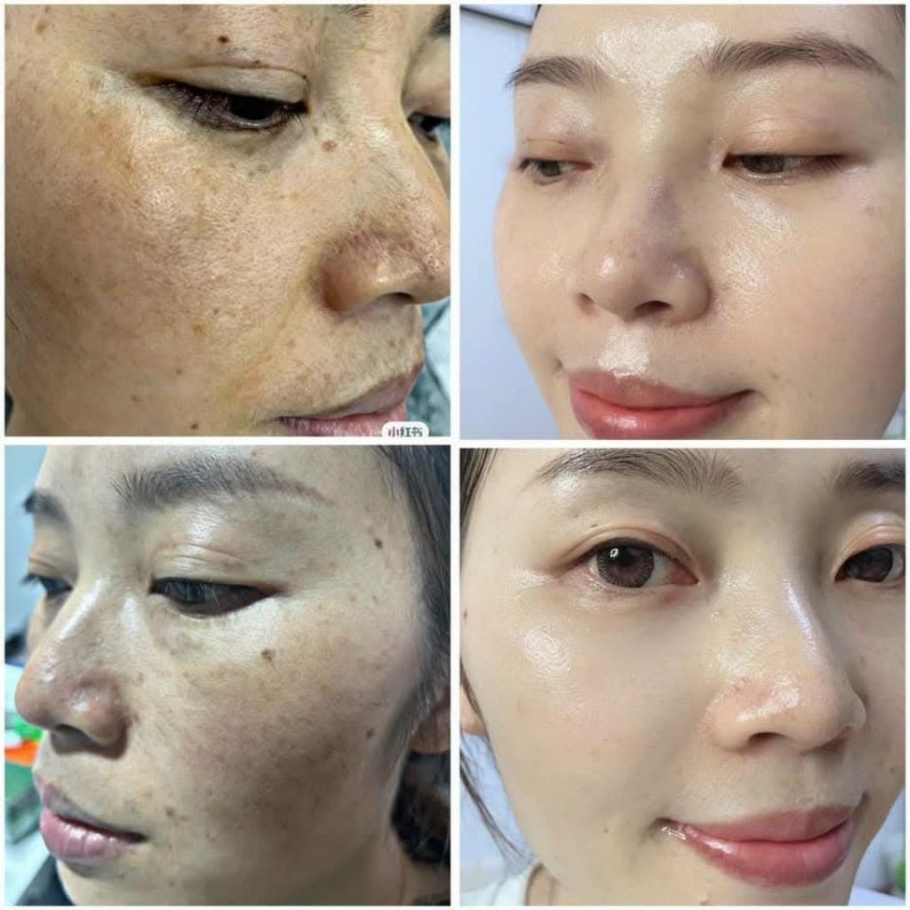 Kem Mờ Thâm Nám Miesho H.A Dưỡng Da Cấp Ẩm Cải Thiện Sắc Tố Da Giúp Da Mịn Màng Bộ 2 Món