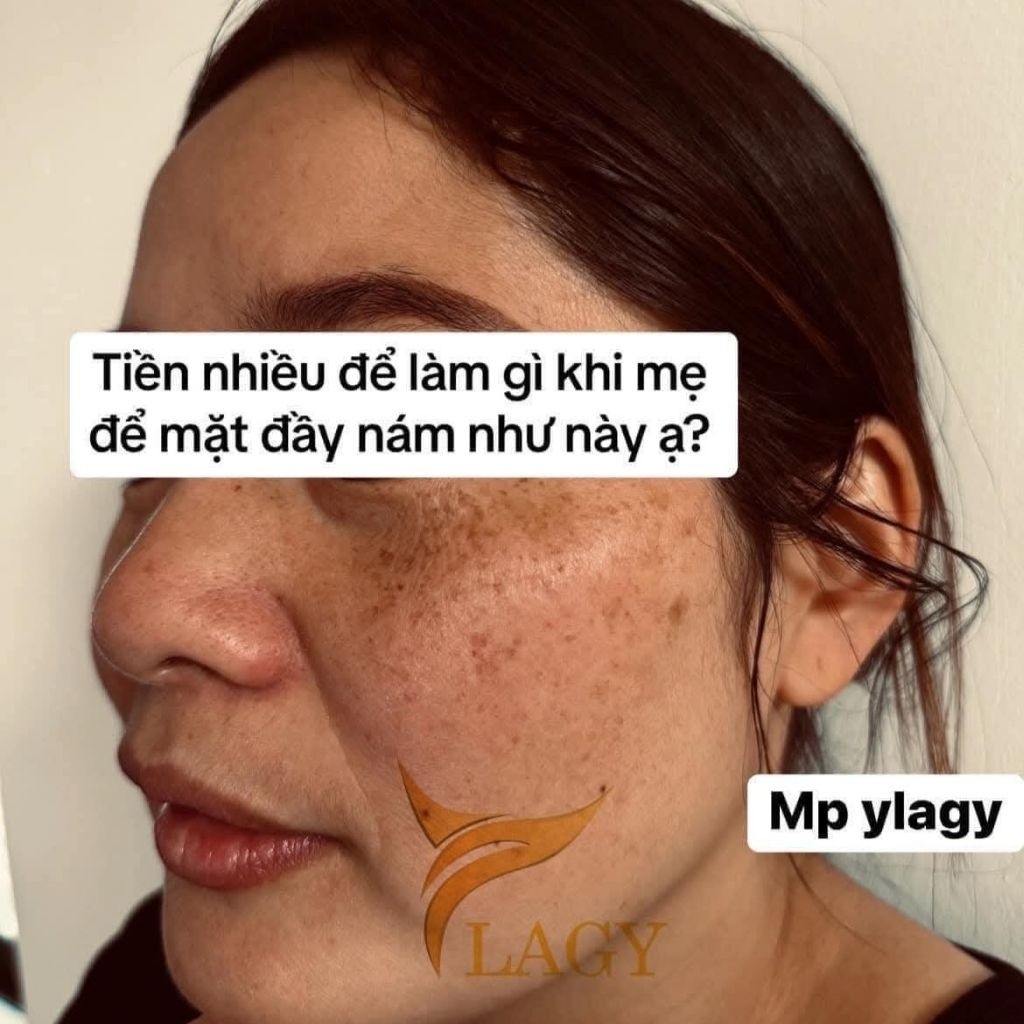 Kem Nám Mờ Thâm Dưỡng Trắng Ylagy Cấp Ẩm Sâu, Phục Hồi Da, Giảm Nám Tàn Nhang, Chống Lão Hóa