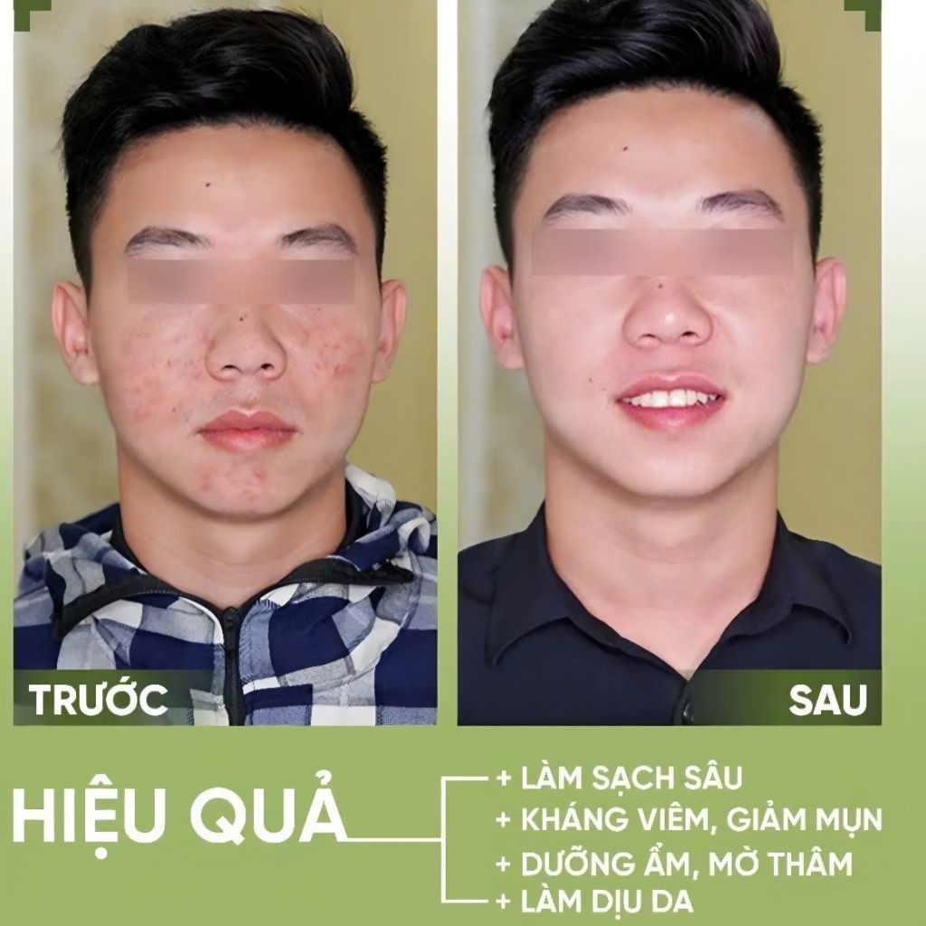 Sữa Rửa Mặt YLAGY Ngừa Mụn Giảm Thâm, Làm Sáng Da, Se Khít Lỗ Chân Lông Tuýp 120ml