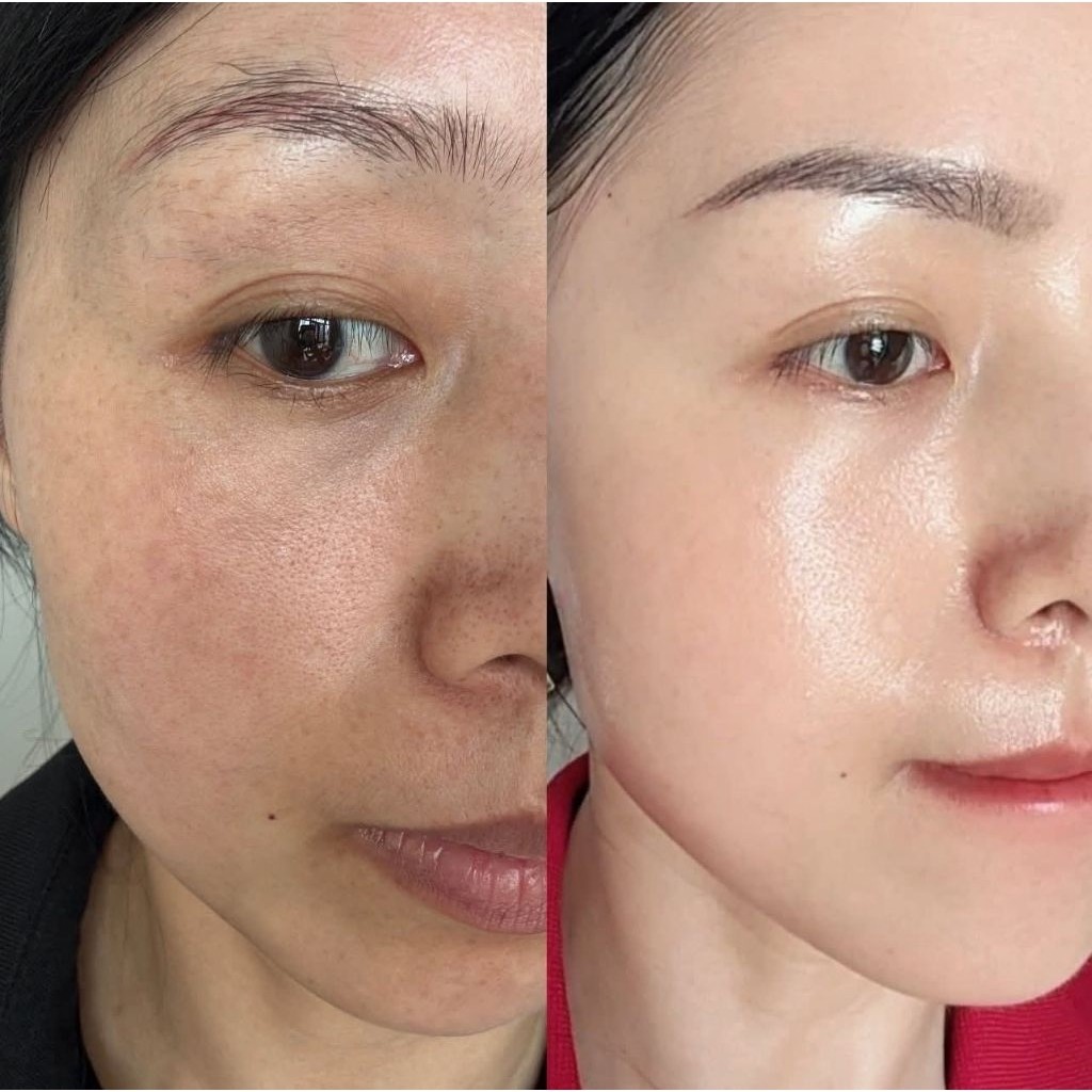 Kem Mờ Thâm Nám Miesho H.A Dưỡng Da Cấp Ẩm Cải Thiện Sắc Tố Da Giúp Da Mịn Màng Bộ 2 Món