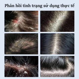 Maigoole Dầu gội cải thiện nấm da đầu Nhật Bản Dầu gội giảm nấm ngứa da đầu, dầu gội dược liệu nấm da đầu, giảm ngứa