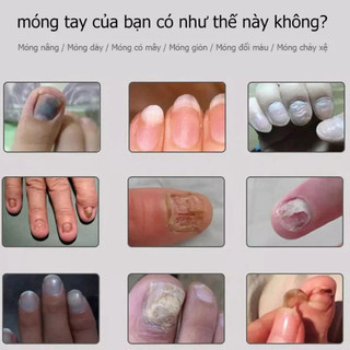 Kem phục hồi móng Móng kháng khuẩn chân loại nấm móng gãy móng chống Kem giúp hết nấm làm thối móng tay móng chân Tinh c