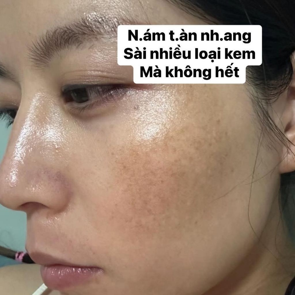 Kem Nám Mờ Thâm Konigin Hỗ Trợ Mờ Thâm Nám, Dưỡng Trắng, Cấp Ẩm Phục Hồi Da Bộ 2 Món