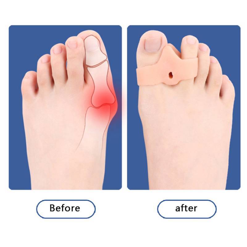 ZK 2 Chiếc Silicone Gel Đôi Vòng Ngón Chân Tách Hallux Valgus Corrector Bunion Protector VN