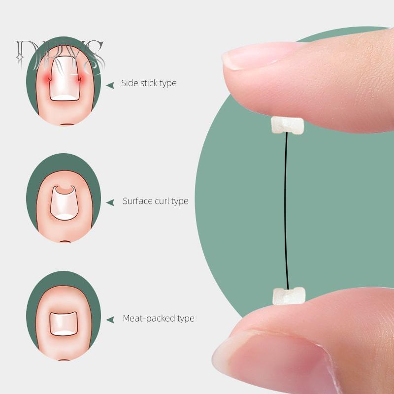 Dụng cụ chỉnh sửa móng mọc ngược, phục hồi móng, chăm sóc bàn chân chuyên nghiệp