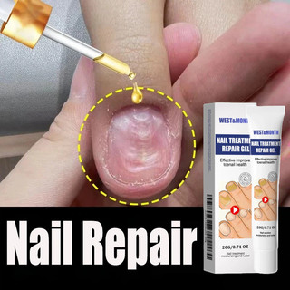 Kem phục hồi móng Móng kháng khuẩn chân loại nấm móng gãy móng chống Kem giúp hết nấm làm thối móng tay móng chân Tinh c