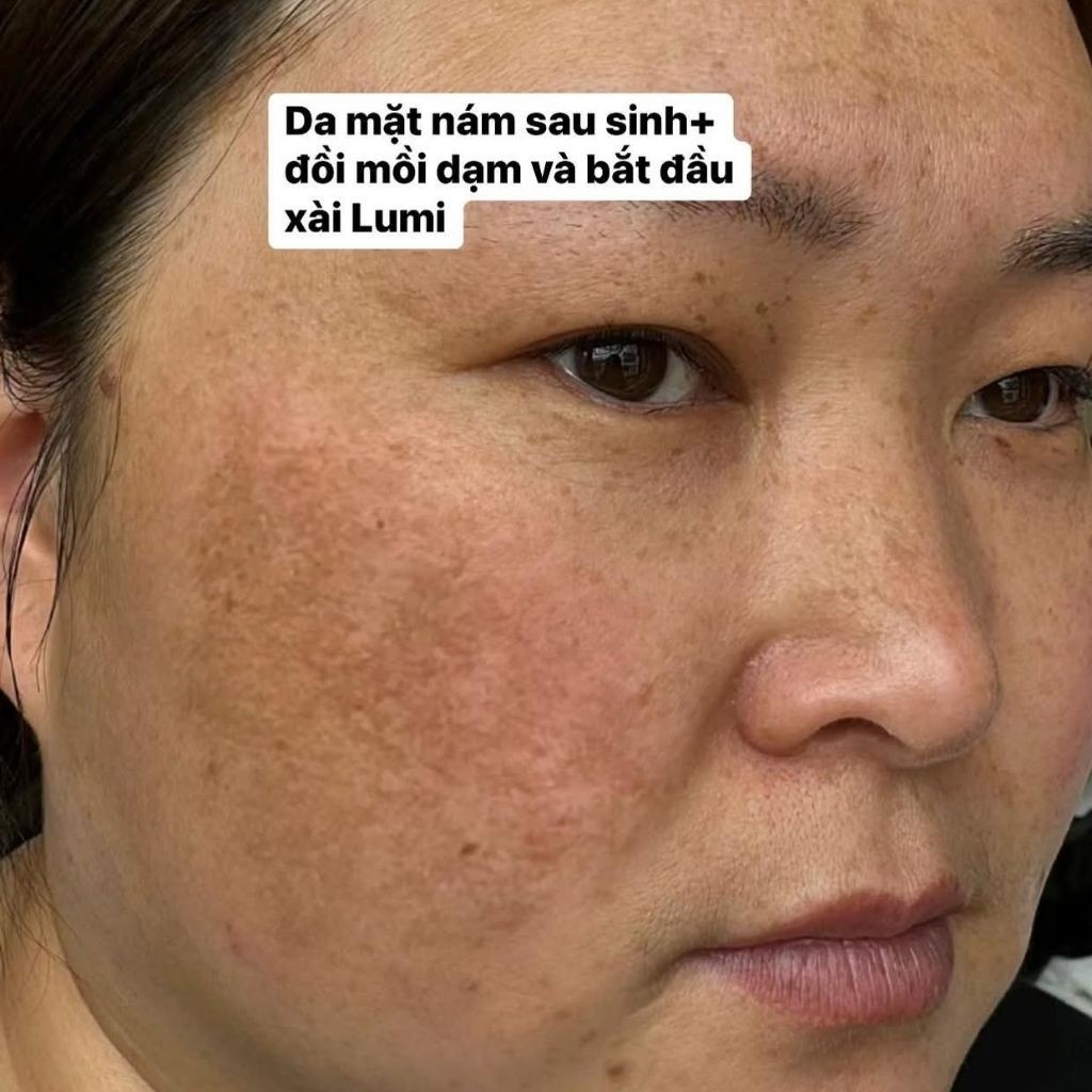 Kem Nám Mờ Thâm Lumi Arbutin Ngày Đêm  Mờ Thâm Nám, Sáng Da, Đều Màu Bộ 2 Món