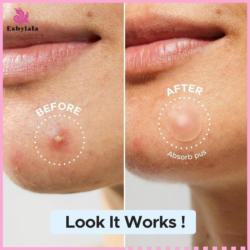 Eshylala Hydrocolloid Miếng Dán Mụn Lớn Nhiều Hình Dạng Vô Hình Bao Da Mụn Cho Cơ Thể Mặt [MỚI]