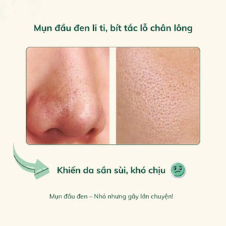 Cây đẩy mụn đầu đen chuyên dụng dùng để loại bỏ mụn đầu đen, tế bào chết Sonbeauty.