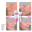 Gel/Cream LSI Quasix 30g – Hỗ Trợ Làm Dịu Da Dầu Nhạy Cảm, Giảm Đỏ Da, Cấp Ẩm Da Khó Chăm Sóc