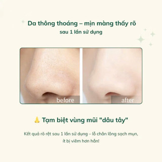 Cây đẩy mụn đầu đen chuyên dụng dùng để loại bỏ mụn đầu đen, tế bào chết Sonbeauty.