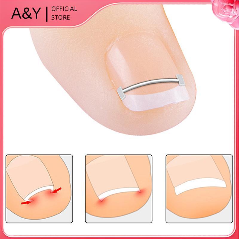Dụng cụ chỉnh sửa móng chân mọc ngược A & Y Phục hồi móng chân Dụng cụ kẹp móng chân mọc ngược chuyên nghiệp.