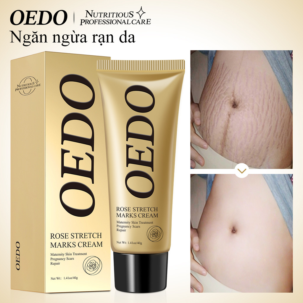 Kem Hỗ Trợ Giảm Sẹo Sau Khi Sinh OEDO chiết xuất hoa hồng Mịn Mượt Chống Lão Hóa Kem Rạn Da 40g