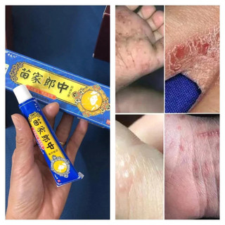 kem bôi nấm ngứa,kem bôi nấm ngứa trung quốc， viêm da cơ địa, vẩy nến, á sừng lang ben, hắc lào - thảo dược tự nhiên，
