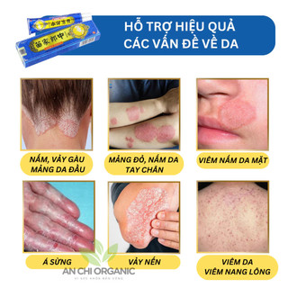 kem bôi nấm ngứa,kem bôi nấm ngứa trung quốc， viêm da cơ địa, vẩy nến, á sừng lang ben, hắc lào - thảo dược tự nhiên，