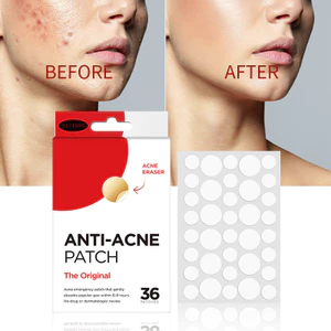 ANTI-ACNE PATCH 36 Chiếc ACNE PATCH Hydrogel Trong Suốt Vô Hình ACNE PATCH