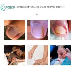 Chenlongshang 8 / 20 Miếng Dán Chỉnh Sửa Móng Tay Cây Trồng Móng Chân Corrector Miếng Dán Paronychia Điều Trị Phục Hồi Corrector Dụng Cụ Làm Móng Chân EN