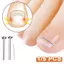 < Honeyba > Dụng cụ chỉnh sửa móng chân mọc ngược Phục hồi móng chân Nhúng ngón chân Điều trị móng chân mọc ngược chuyên nghiệp Dụng cụ kẹp thẳng móng chân đẹp