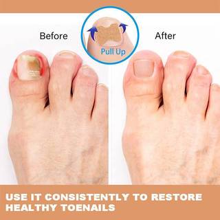 JRP 60 Chiếc Cây Phát Triển Móng Tay Chỉnh Sửa Móng Chân Chân Corrector Miếng Dán Paronychia Điều Trị Phục Hồi Corrector Dụng Cụ Chăm Sóc Móng Tay JRP