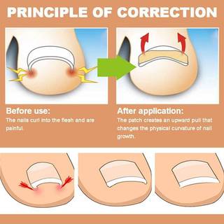 JRP 60 Chiếc Cây Phát Triển Móng Tay Chỉnh Sửa Móng Chân Chân Corrector Miếng Dán Paronychia Điều Trị Phục Hồi Corrector Dụng Cụ Chăm Sóc Móng Tay JRP