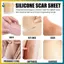 BVY 4cm * 50cm Silicone Tấm Loại Bỏ Dải Gel Silicon Sẹo Dải Cho Phẫu Thuật Keloid Đốt Sẹo Miếng Dán.