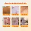Hỗ trợ làm khô mụn thịt, mụn cóc với kem hỗ trợ làm mềm và phục hồi da-QY4