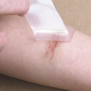 Miếng dán sẹo silicone gel (Silicone Gel Sheet) của hãng Wanhe dùng để hỗ trợ loại bỏ sẹo.