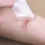 Miếng dán sẹo silicone gel (Silicone Gel Sheet) của hãng Wanhe dùng để hỗ trợ loại bỏ sẹo.