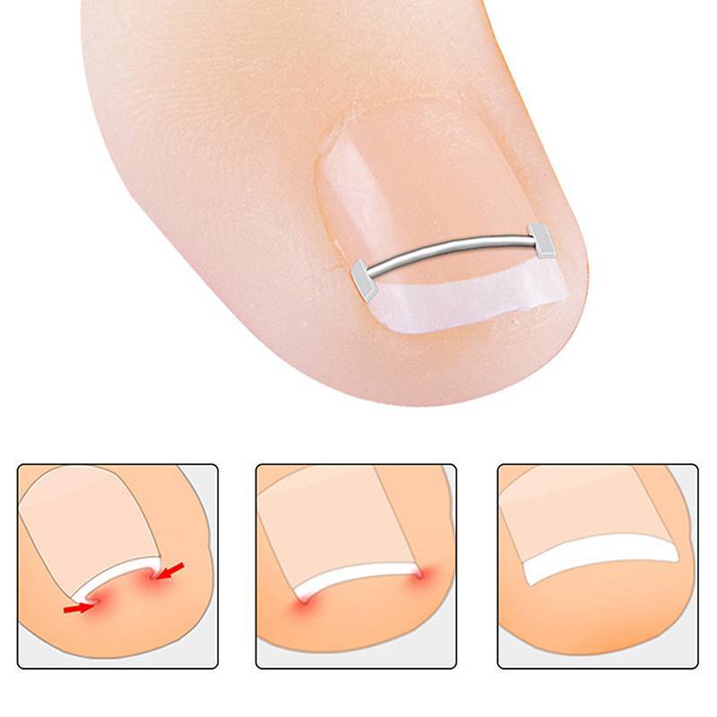 Dụng cụ chỉnh sửa móng chân mọc ngược Eshylala Kẹp làm thẳng phục hồi móng chân chuyên nghiệp [MỚI]