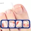 Miếng dán chỉnh sửa móng chân mọc ngược chiều dài 30 / 50 / 100cm Miếng dán điều trị móng chân mọc ngược Miếng dán cắt thẳng DIY Dụng cụ làm móng chân