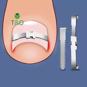 Dụng cụ chỉnh sửa móng chân mọc ngược Phục hồi móng chân Nhúng ngón chân Điều trị móng chân mọc ngược chuyên nghiệp Dụng cụ chăm sóc bàn chân [mới]