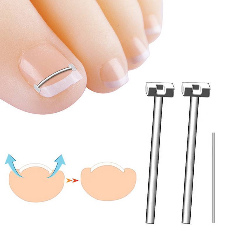 Dụng cụ chỉnh sửa móng chân mọc ngược Eshylala Kẹp làm thẳng phục hồi móng chân chuyên nghiệp [MỚI]