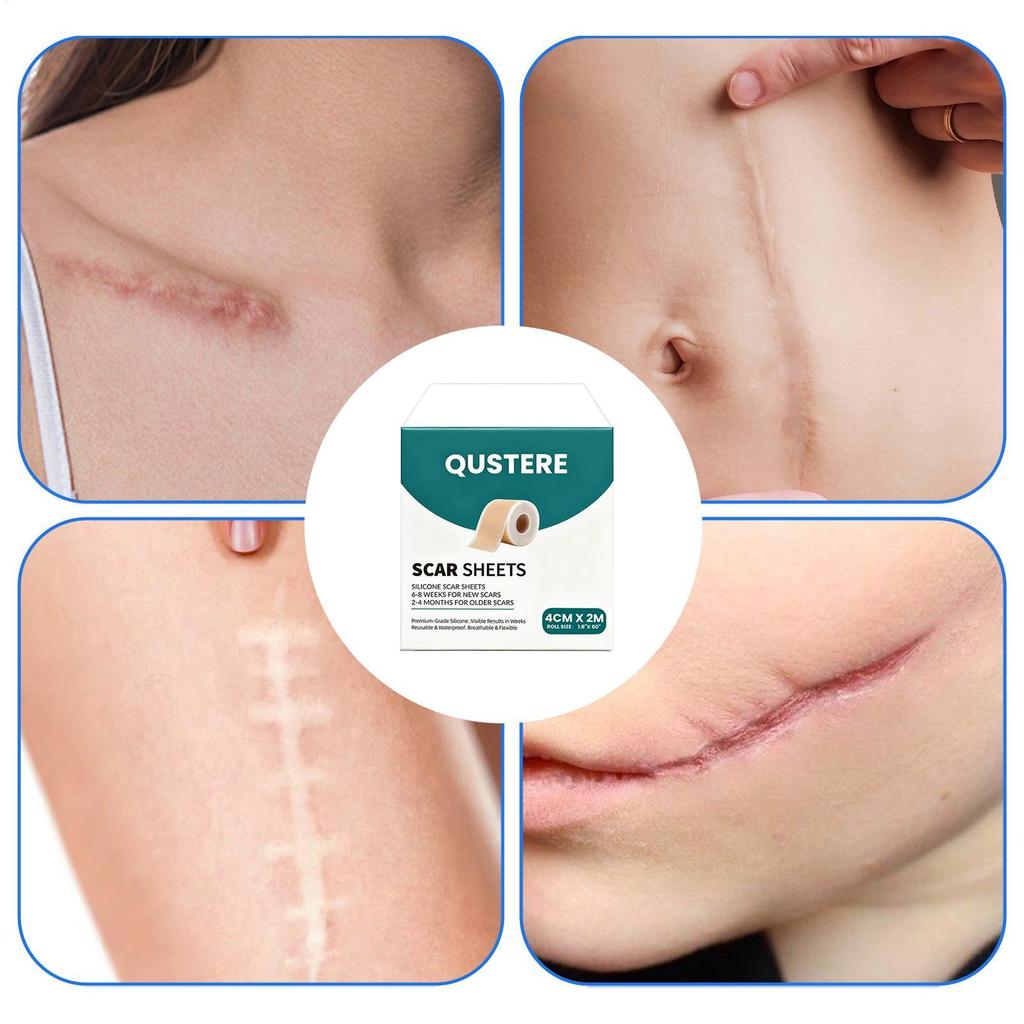 Dải sẹo silicon Chống thấm nước Thoáng khí Miếng dán Tummy Tuck Miếng dán sẹo Cuộn cho phần C Tummy Tuck Sau sinh ewoekvn