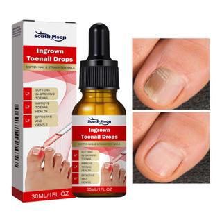 Máy làm mềm móng chân mọc ngược 30ML Thuốc giảm cảm giác khó chịu Dụng cụ chỉnh sửa móng chân mọc ngược cho vết bẩn màu vàng ewoekvn