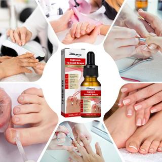 Máy làm mềm móng chân mọc ngược 30ML Thuốc giảm cảm giác khó chịu Dụng cụ chỉnh sửa móng chân mọc ngược cho vết bẩn màu vàng ewoekvn