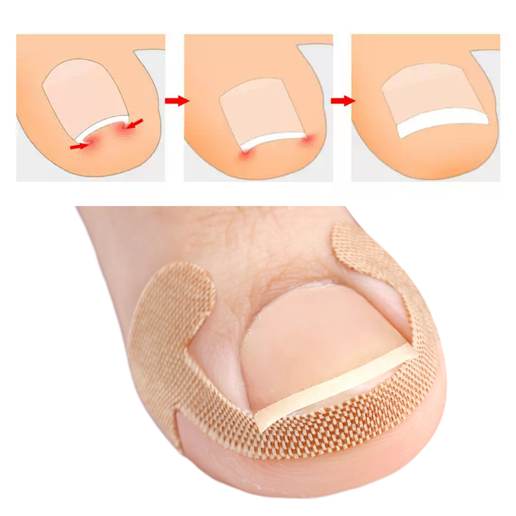 100 Miếng dán móng chân dính để chỉnh sửa móng tay mọc ngược - Dải điều trị móng tay chống nhiễm trùng - Ứng dụng dễ dàng Dụng cụ chăm sóc bàn chân dùng một lần