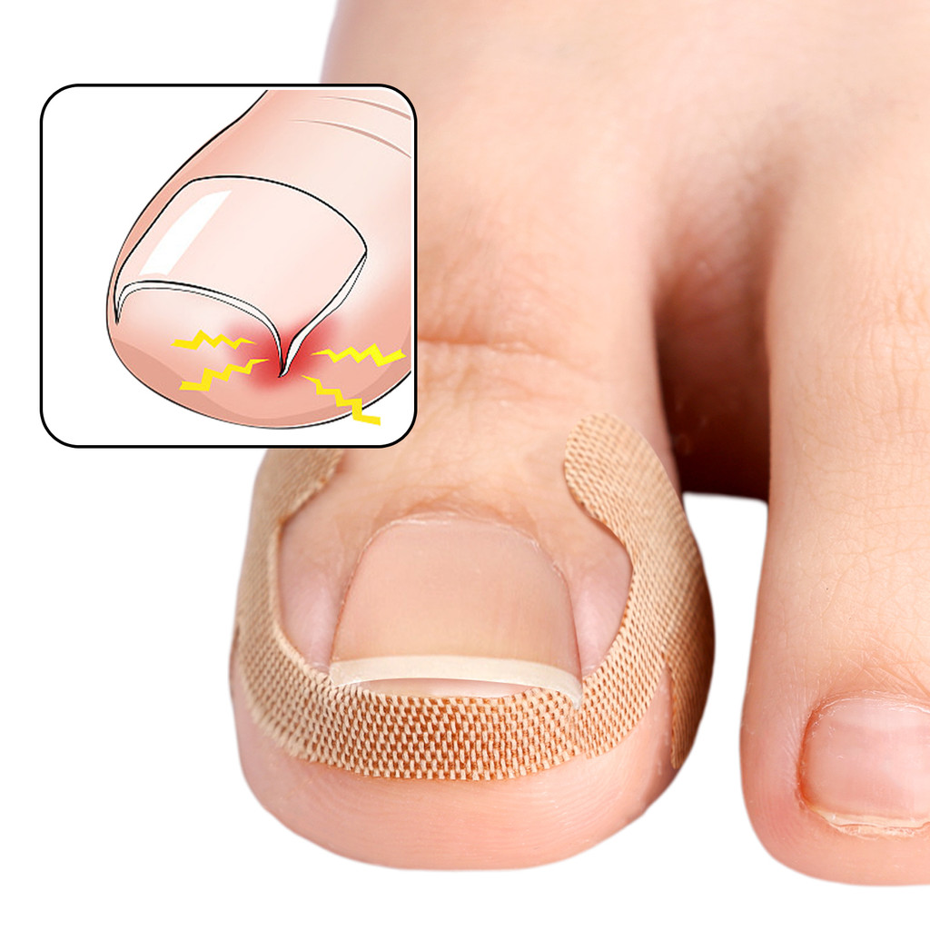 100 Miếng dán móng chân dính để chỉnh sửa móng tay mọc ngược - Dải điều trị móng tay chống nhiễm trùng - Ứng dụng dễ dàng Dụng cụ chăm sóc bàn chân dùng một lần