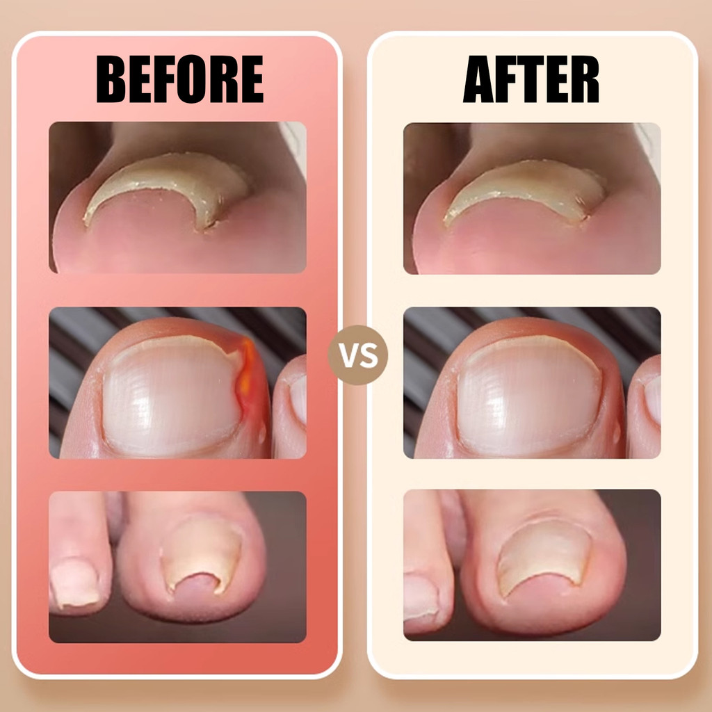 100 Miếng dán móng chân dính để chỉnh sửa móng tay mọc ngược - Dải điều trị móng tay chống nhiễm trùng - Ứng dụng dễ dàng Dụng cụ chăm sóc bàn chân dùng một lần